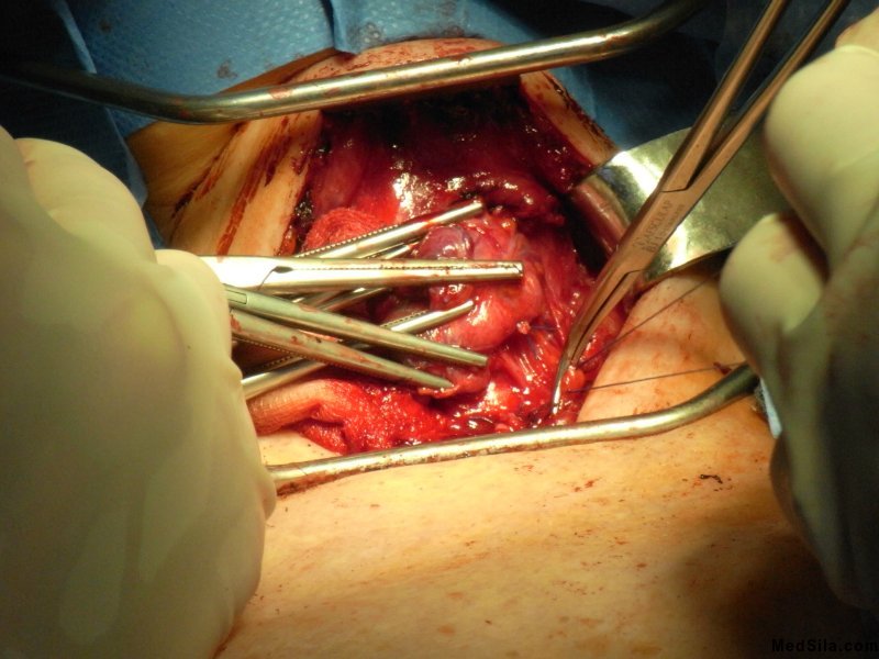 Тиреоидэктомия